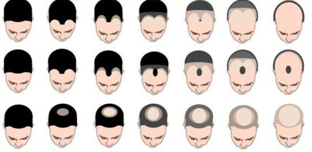 Crowning Glory Chronicles Navigating The Genetic Maze Of Hair Loss